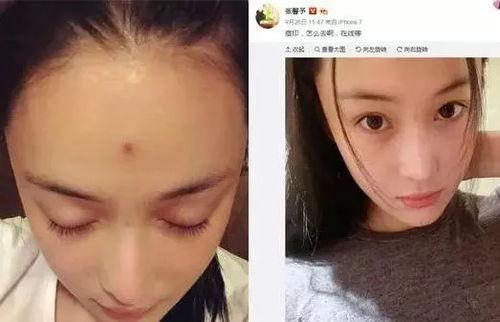明星长痘吗,揭秘明星护肤背后的秘密